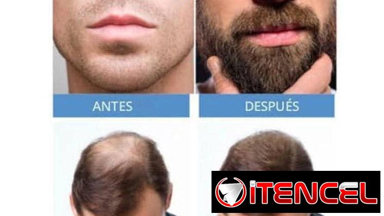Minoxidil: Tratamiento para el crecimiento del cabello.