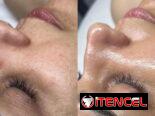 Limpieza Facial | Hidratación | Tratamiento para manchas, acné, lineas de expresión. .