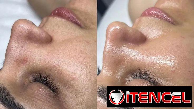 Limpieza Facial | Hidratación | Tratamiento para manchas, acné, lineas de expresión. .
