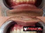 Blanqueamiento Dental Profesional