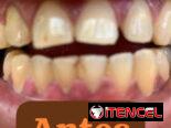 Se realiza limpieza dental y blanqueamiento
