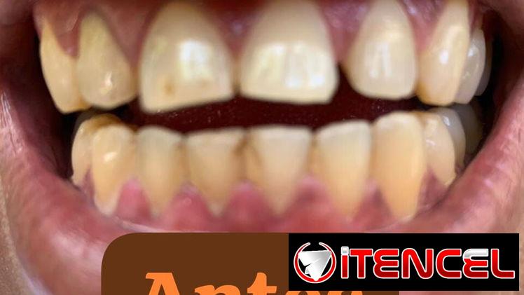 Se realiza limpieza dental y blanqueamiento