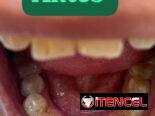 Se realiza limpieza dental y blanqueamiento