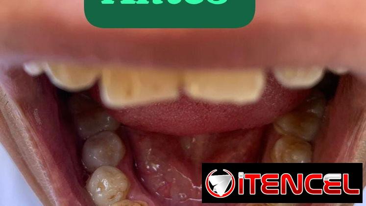 Se realiza limpieza dental y blanqueamiento