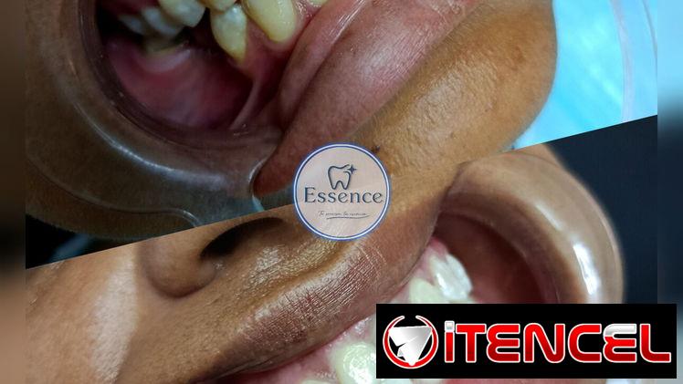 Blanqueamientos y Limpiezas Dentales