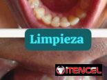Se realiza limpieza dental y blanqueamiento