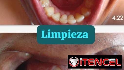 Se realiza limpieza dental y blanqueamiento