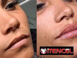 OFERTA DE VERANO CON ACIDO HIALURÓNICO. Tecnica lifting facial y el aumento de labios en Spa Leydis. 🌸 Marianao