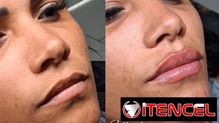 OFERTA DE VERANO CON ACIDO HIALURÓNICO. Tecnica lifting facial y el aumento de labios en Spa Leydis. 🌸 Marianao