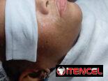 Limpieza facial profunda con Aparatologia