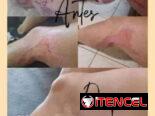 Elimina cicatrices dermatitis psoriasis cortaduras estarías picaduras ezcemas rosácea