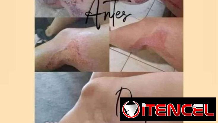 Elimina cicatrices dermatitis psoriasis cortaduras estarías picaduras ezcemas rosácea