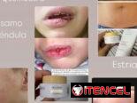 Elimina cicatrices dermatitis psoriasis cortaduras estarías picaduras ezcemas rosácea