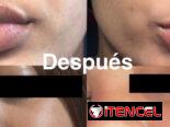 Crema quita manchas Carotone Original