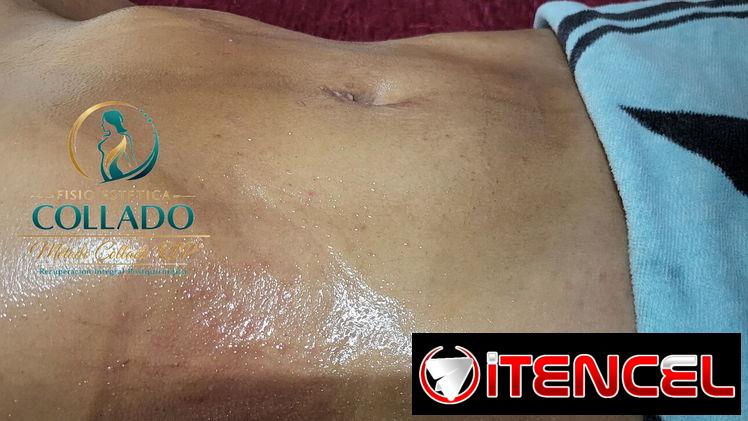 ✅ DRENAJE LINFÁTICO POST QUIRÚRGICOS MASAJES POST OPERATORIO APARATOLOGIA ASESORÍA DOMICILIO GRATIS