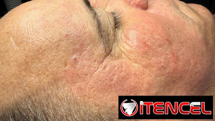 Limpiezas faciales — foto 1