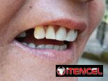 Prótesis Dental parciales y totales removible de acrílico