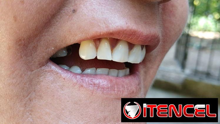 Prótesis Dental parciales y totales removible de acrílico