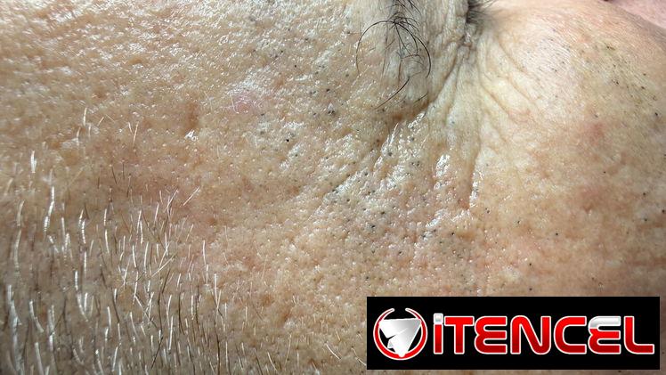Limpiezas faciales — foto 3