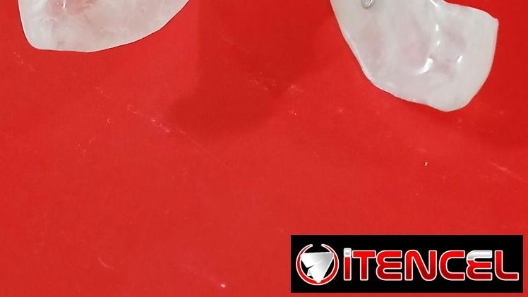 Prótesis Dental parciales y totales removible de acrílico