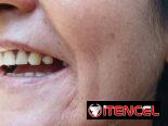 Prótesis Dental parciales y totales removible de acrílico