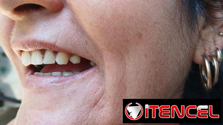 Prótesis Dental parciales y totales removible de acrílico
