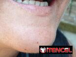 Prótesis Dental parciales y totales removible de acrílico