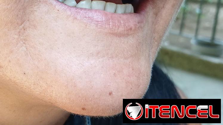 Prótesis Dental parciales y totales removible de acrílico