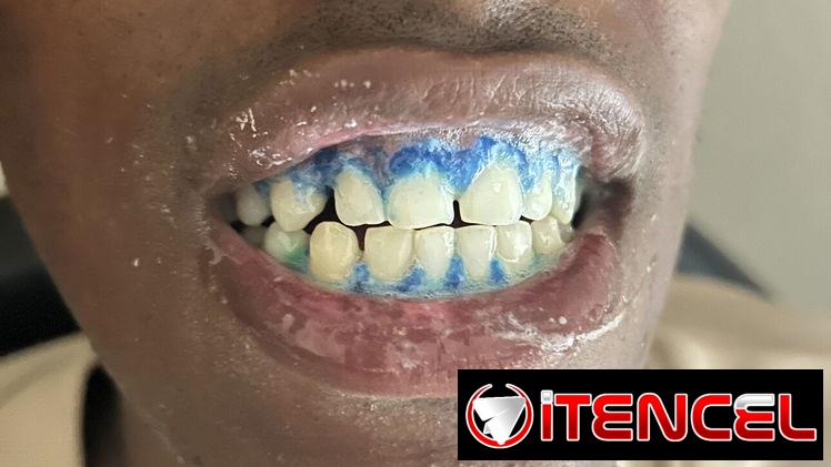 Blanqueamiento y limpieza dental — foto 3