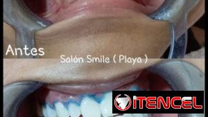 Blanqueamiento y limpieza dental