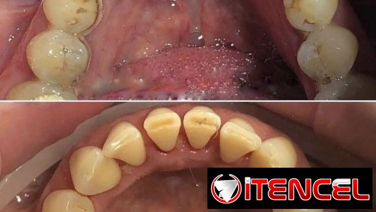 Blanqueamiento y limpieza dental — foto 2