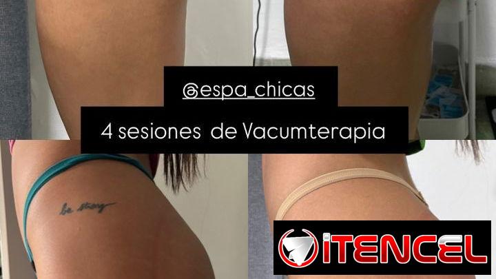 VACUMTERAPIA DE GLÚTEOS CON COPAS COLOMBIANAS EN LA HABANA  ¿Quieres mejorar la apariencia de tus glúteos? ✨  En Espa Ch